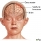 Heart Rate Variability as an indicator for intracranial pressure