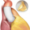 Klepsparende aortawortel vervanging