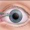 Eye surgery