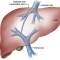 Transjugular intrahepatic portosystemic shunt